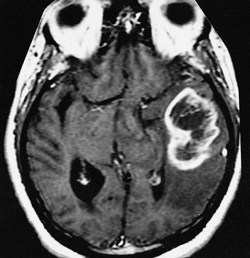 axial post-contrast brain MRI